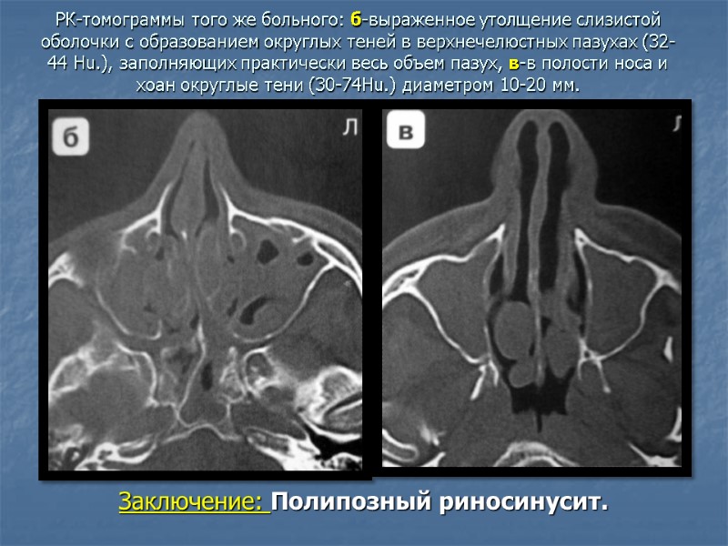 РК-томограммы того же больного: б-выраженное утолщение слизистой оболочки с образованием округлых теней в верхнечелюстных